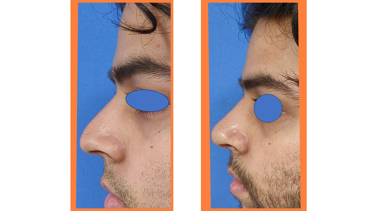 Rhinoplasty Photo 12